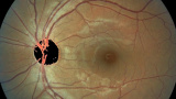 Desarrollan en la UG algoritmo para el análisis de fondo de ojo en pacientes con diabetes