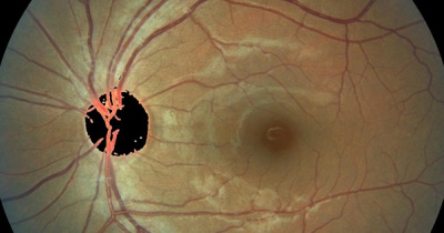 Desarrollan en la UG algoritmo para el análisis de fondo de ojo en pacientes con diabetes
